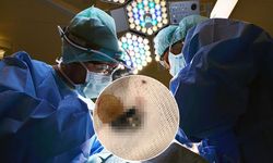 1,5 yaşındaki bebeğin yuttuğu cisim bağırsaklarını deldi!