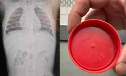 Sürekli ağlıyordu: Bebeğin sırtından çıkan şoke etti