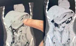 Zayıflamak için canından oluyordu: Midesinden çıkan...