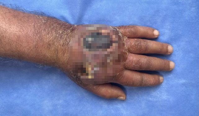 Elini ısırdı bu hale geldi! Kolu kesilmekten son anda kurtuldu