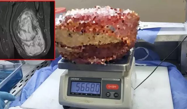Bacağından çıkana inanamadı! Tam 5 kilo…