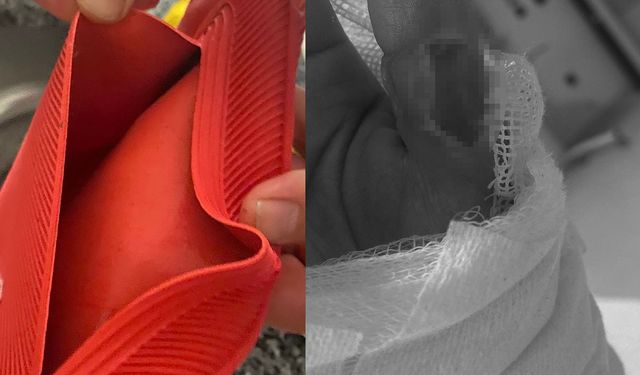 Sıcak su torbası kabusu oldu! Vücudunun yüzde 25’i yandı