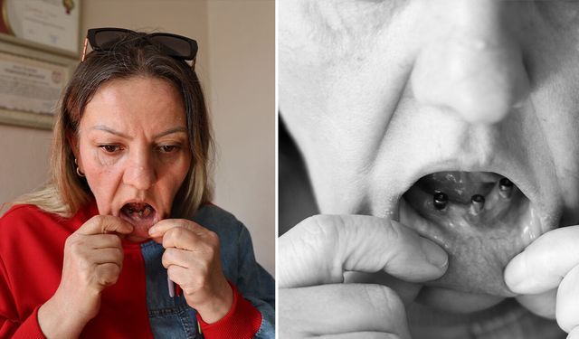 Diş ağrısıyla gitti, kabusu yaşadı! Tam 25 dişi birden çekildi