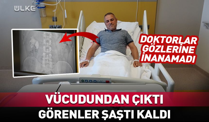 Vücudundan çıkanları görenler şaştı kaldı! 100'e yakın...