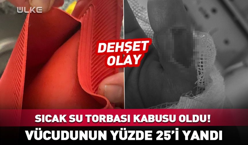 Sıcak su torbası kabusu oldu! Vücudunun yüzde 25’i yandı