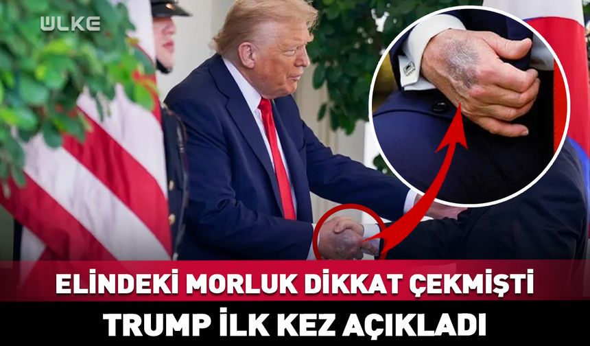 Trump elindeki morlukların sebebini açıkladı!