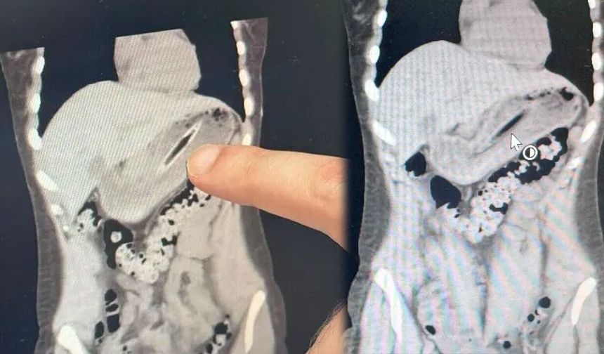 Bakın zayıflamak için ne yapmış! Canından oluyordu