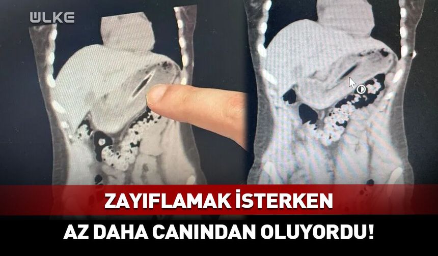 Zayıflamak için canından oluyordu: Midesinden çıkan...