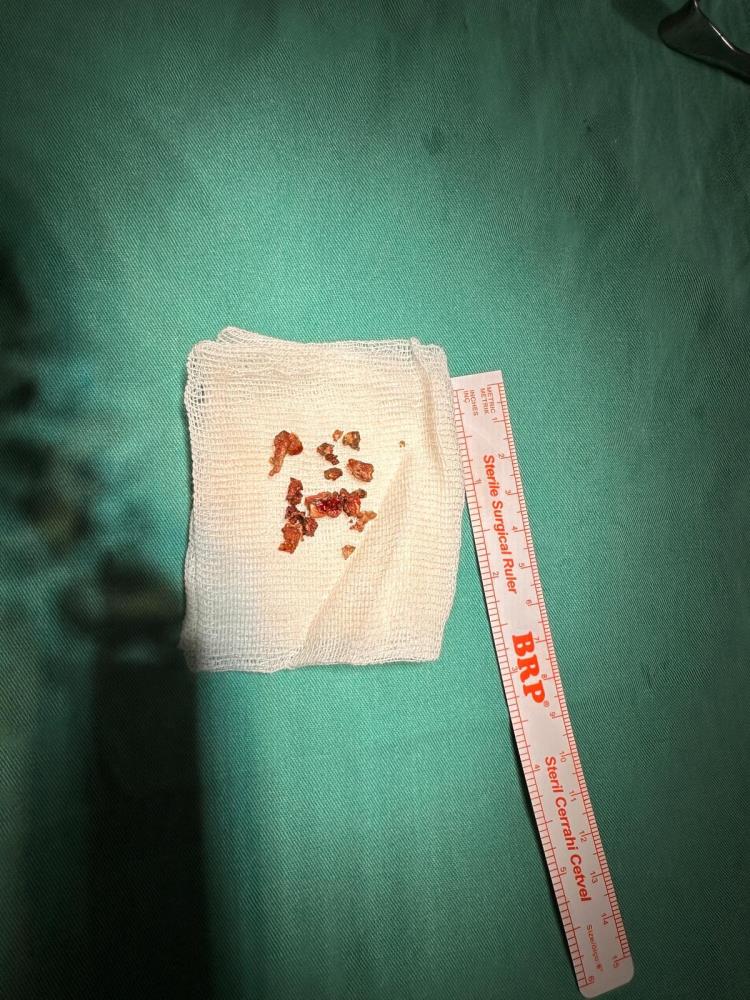 Ameliyatta Burundan Çıkan Cisim (1)