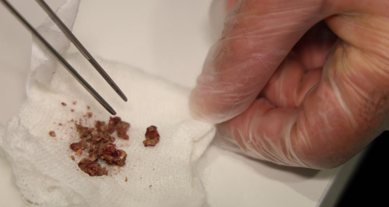 Ameliyatta Burundan Çıkan Cisim (4)