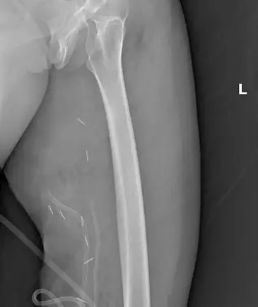 Bacağından 5 Kilo Kütle Çıktı (1)