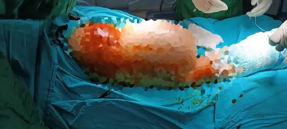 Bacağından 5 Kilo Kütle Çıktı (2)