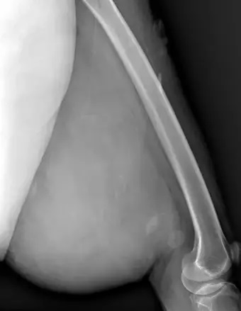 Bacağından 5 Kilo Kütle Çıktı (3)