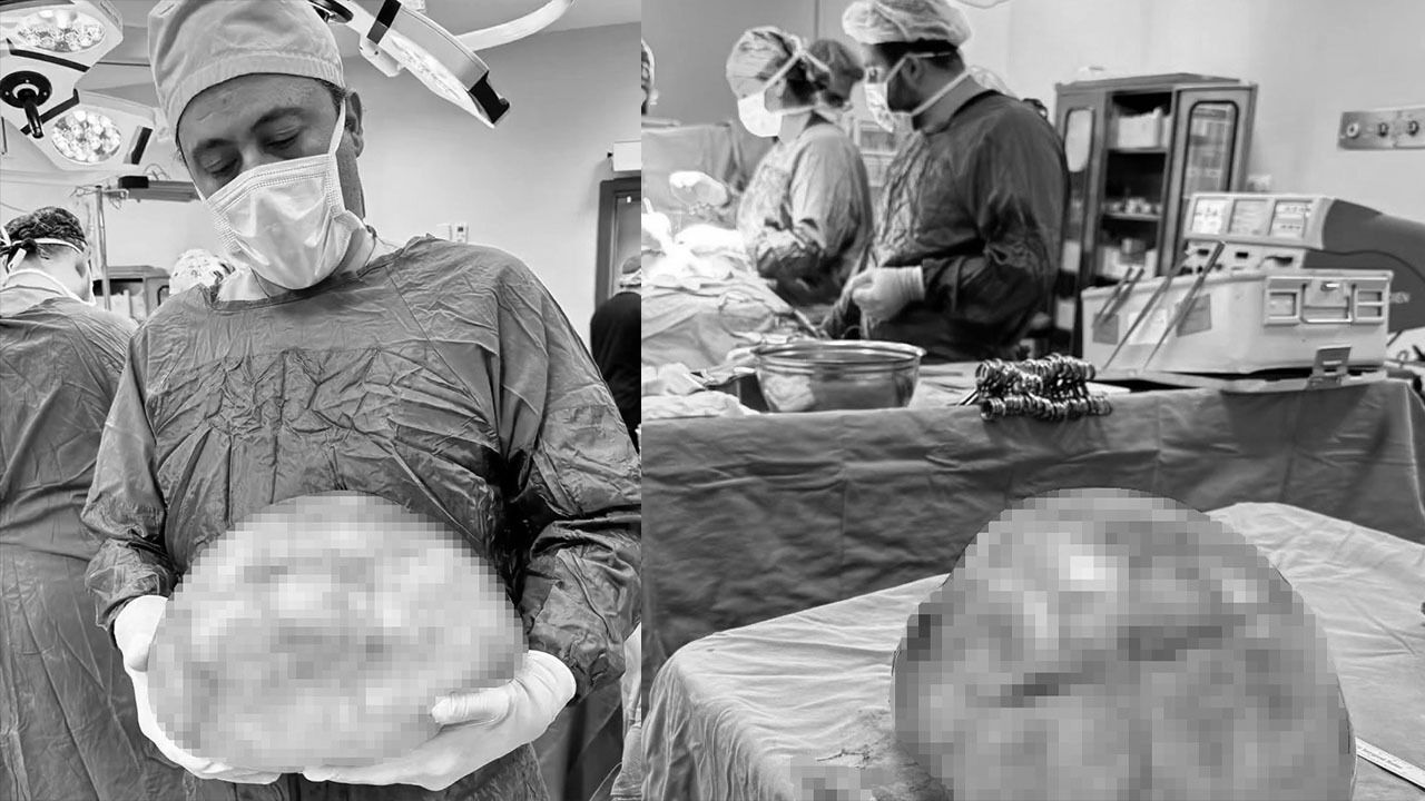 Görenleri hayrete düşürdü! Karnından tam 35 santimetrelik kitle çıktı