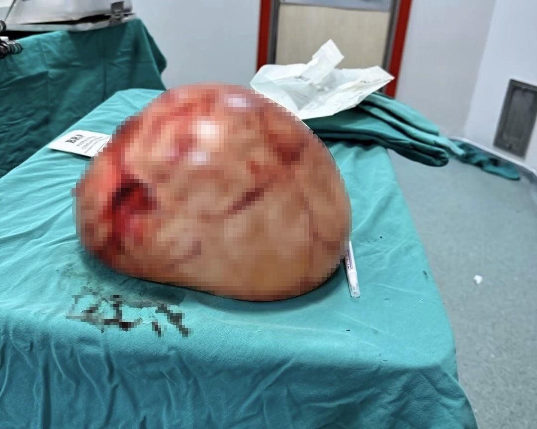 35 Santimetrelik Kitle Çıkarıldı (3)