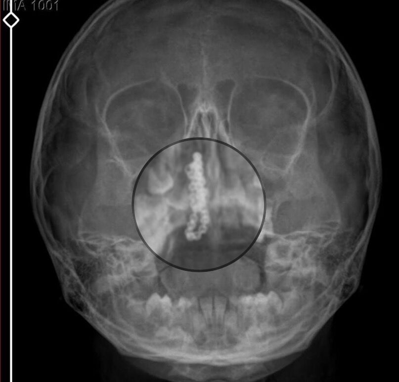 5 Y A S I N D A K I P O L E N 2 Y I L D I R B U R N U N D A T I R 1230914 366118