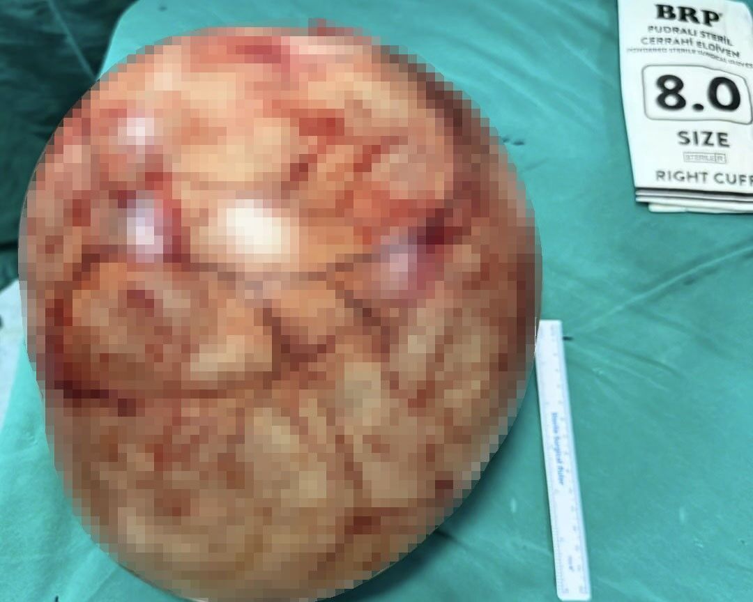 35 santimetrelik dev kitle