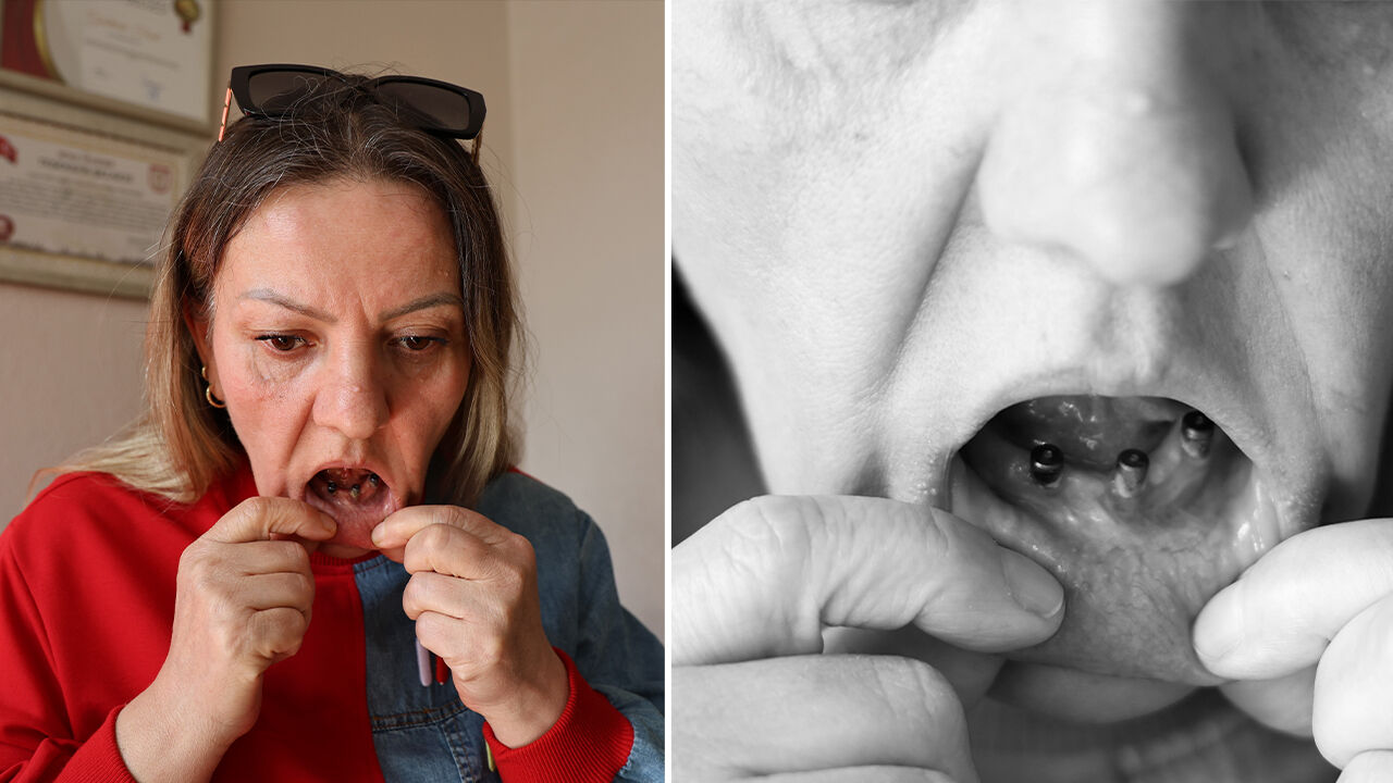 Diş ağrısıyla gitti, kabusu yaşadı! Tam 25 dişi birden çekildi