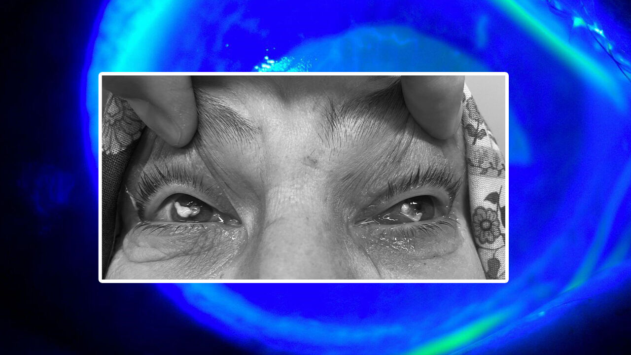 Gözlerine damlattı, göremez hale geldi! Uzmanından önemli uyarı