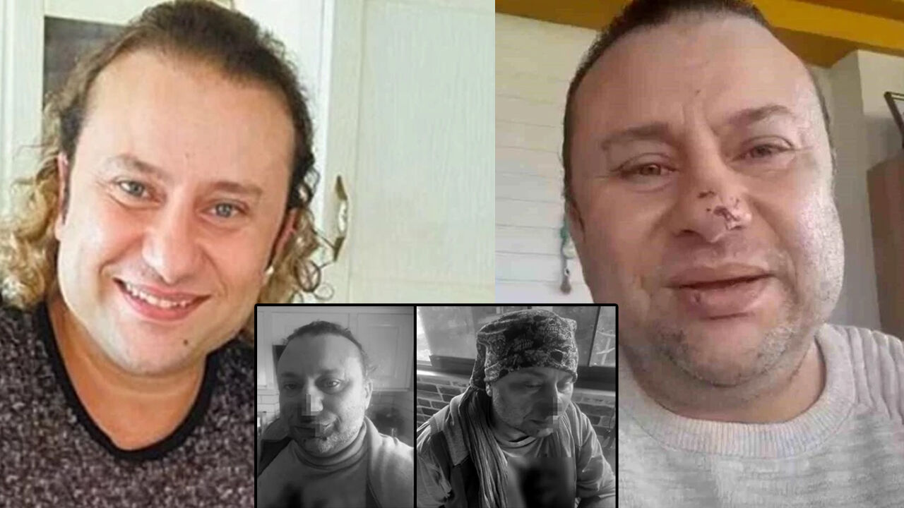 Pitbull saldırısına uğramış, entübe edilmişti! Onur Akay yaşadığı korku dolu anları anlattı